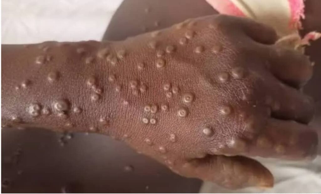 MPOX IN CRS