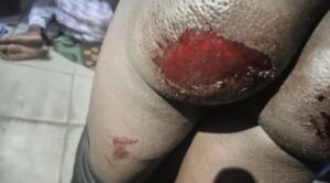 Futo student injuries from man o’ war 